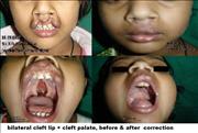 Before After Pictures,Cosmetic surgery,Delhi, bilateral cleft lip + palate